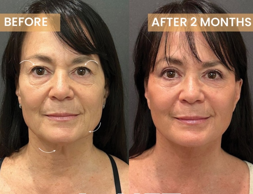 Sacramento facelift