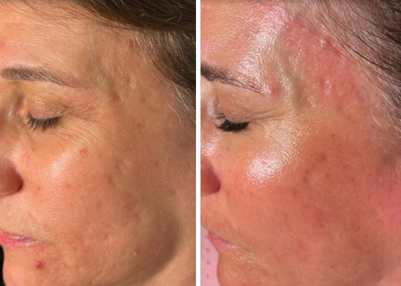 Microneedling results Roseville