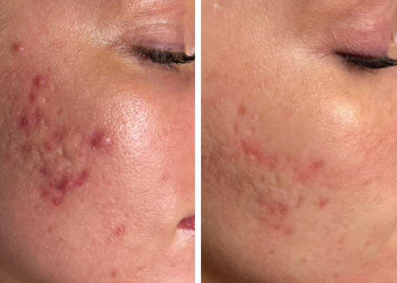 Microneedling Roseville