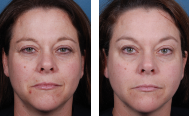 Chemical Peels Roseville