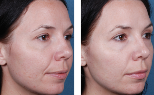 Chemical Peels procedure Roseville