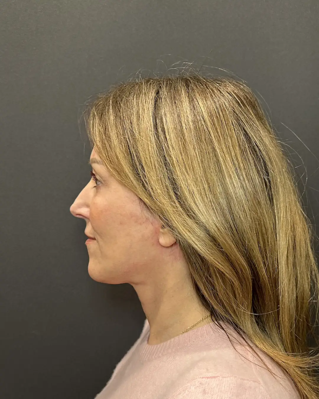 Facial Plastic Surgery and How It Benefits You