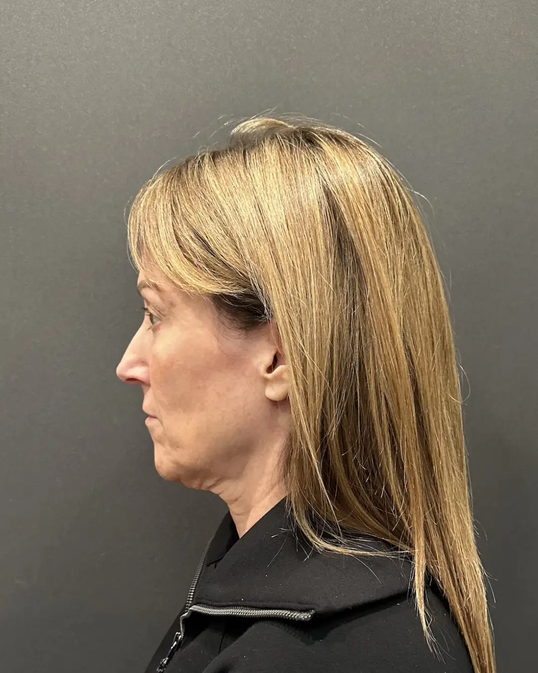 Facial Plastic Surgery and How It Benefits You