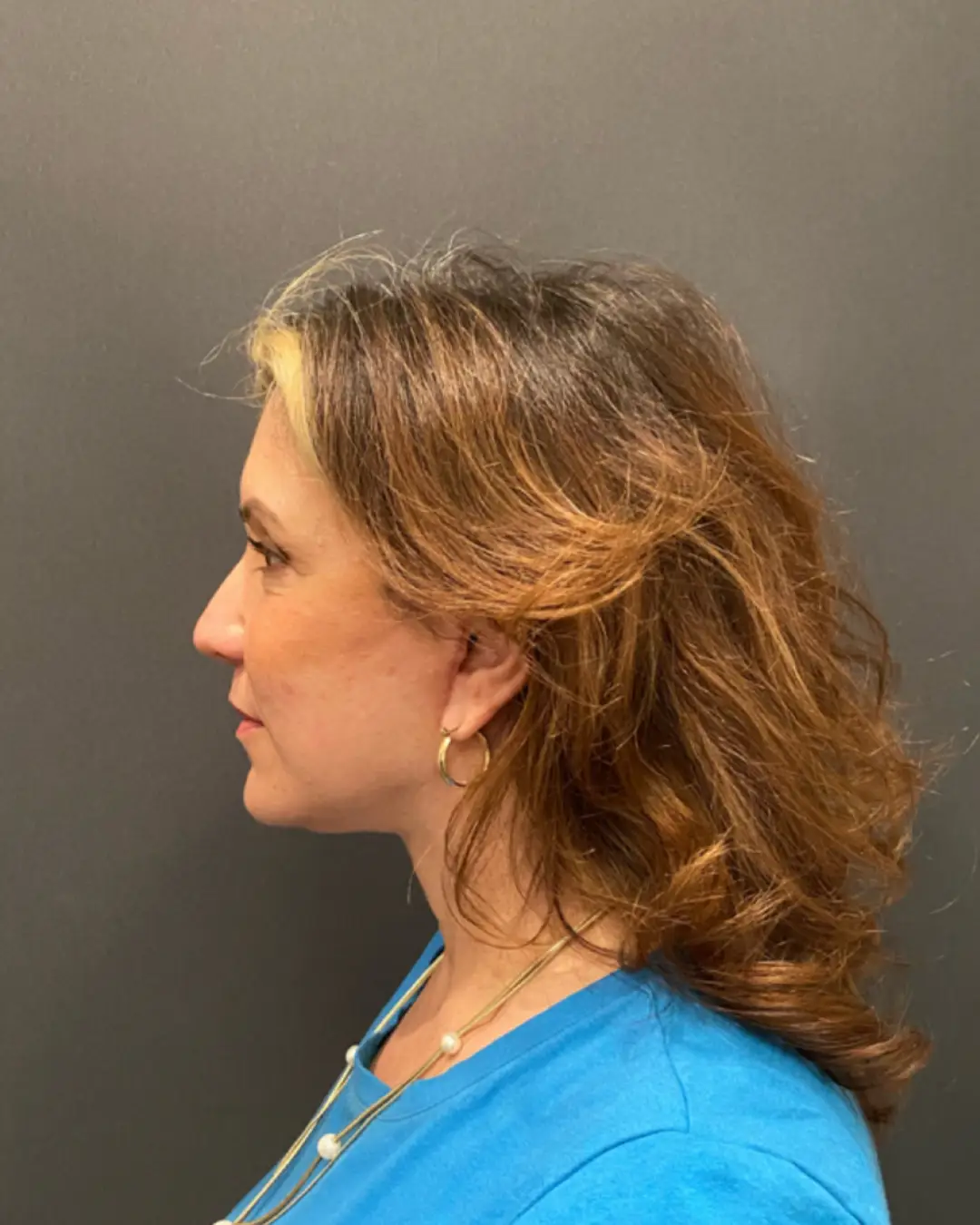 After Facelift Sacramento CA