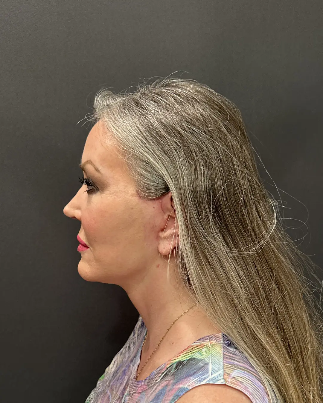 After Facelift Sacramento CA