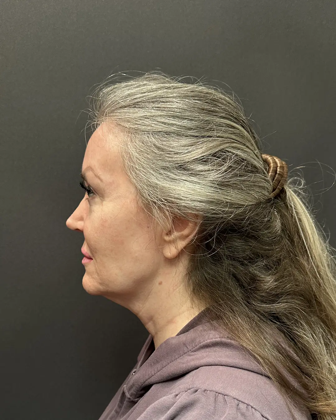 Before Facelift Sacramento CA