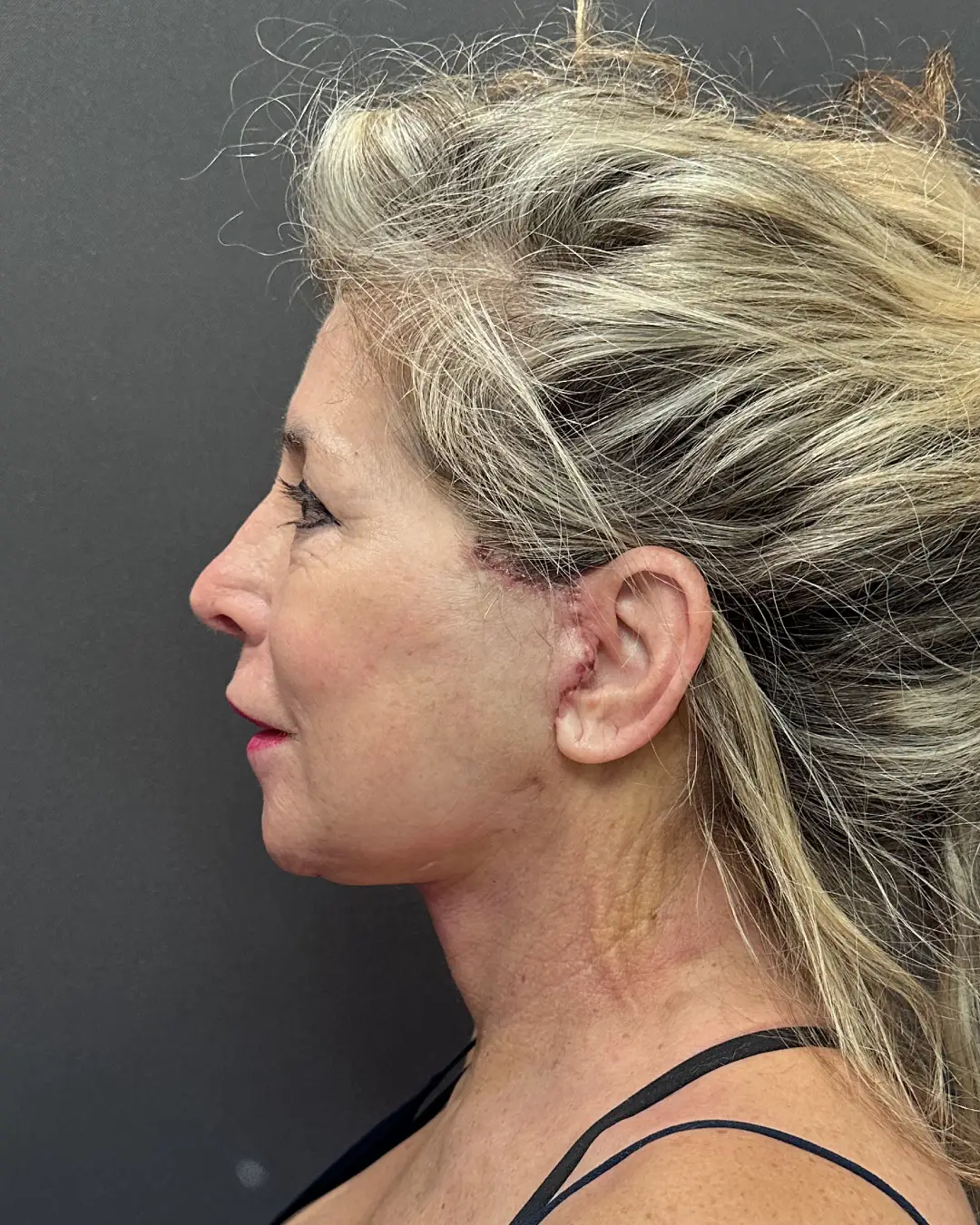 Facial Plastic Surgery and How It Benefits You