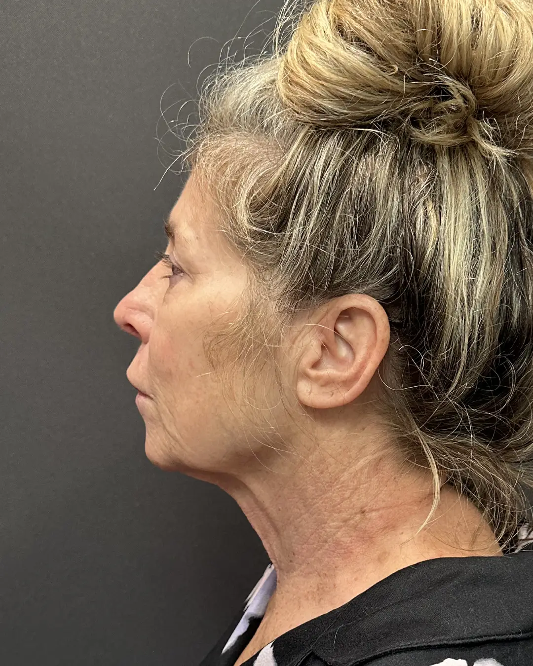 Facial Plastic Surgery and How It Benefits You