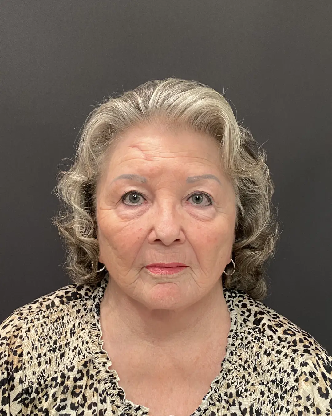 After Facelift Sacramento CA
