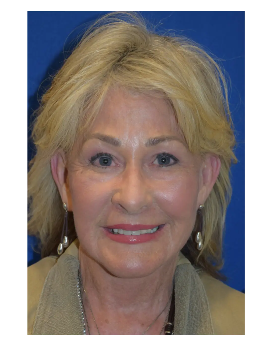 After Facelift Sacramento CA